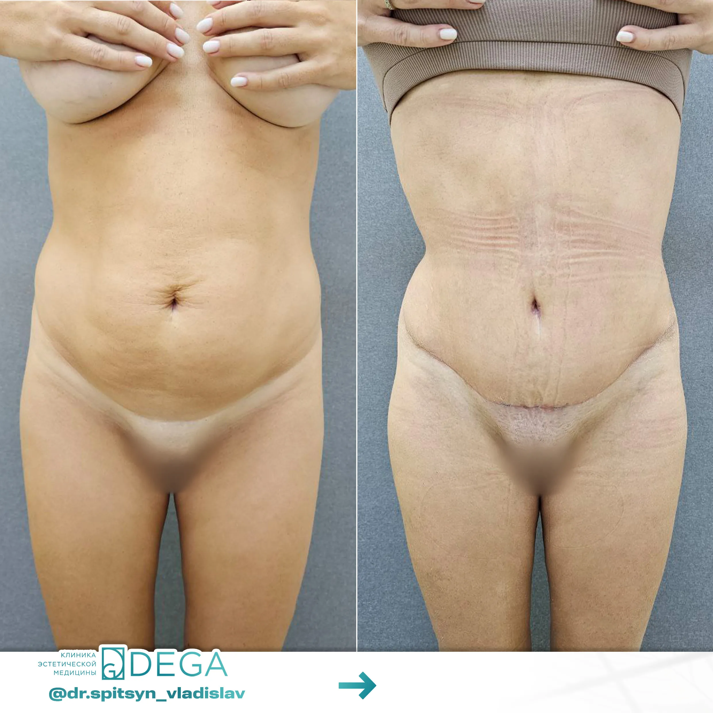 Спицын ВИ - Абдоминопластика, Липосакция тела №45