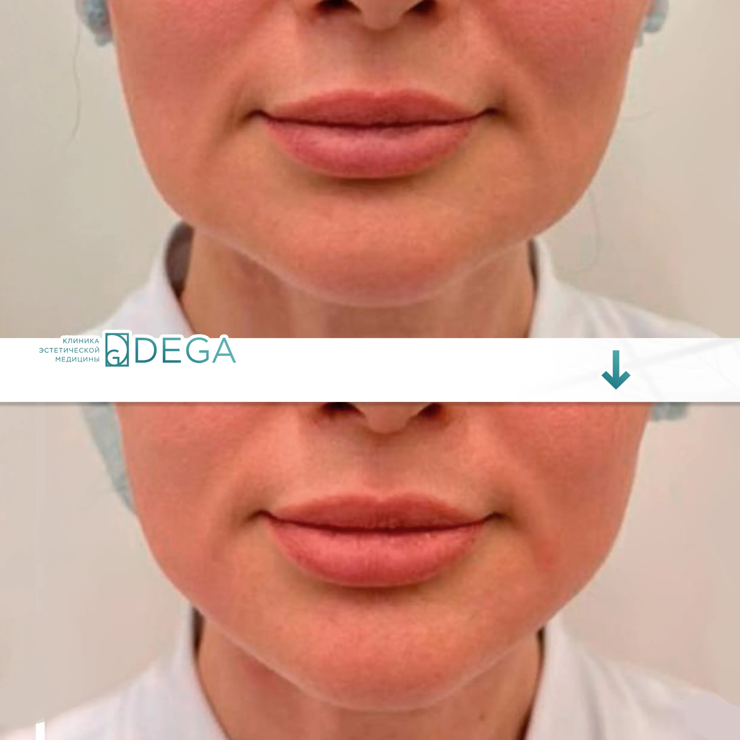 Андрян КВ - Монополярный RF-лифтинг Oligio №29