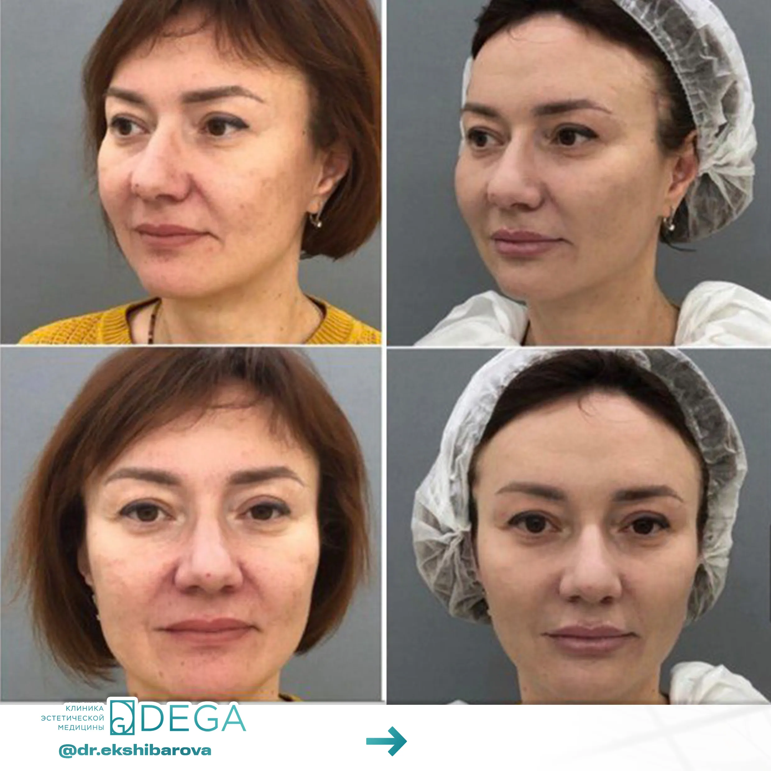 Екшибарова НИ - Контурная пластика, Лазерная косметология, Аппаратаня косметология №28