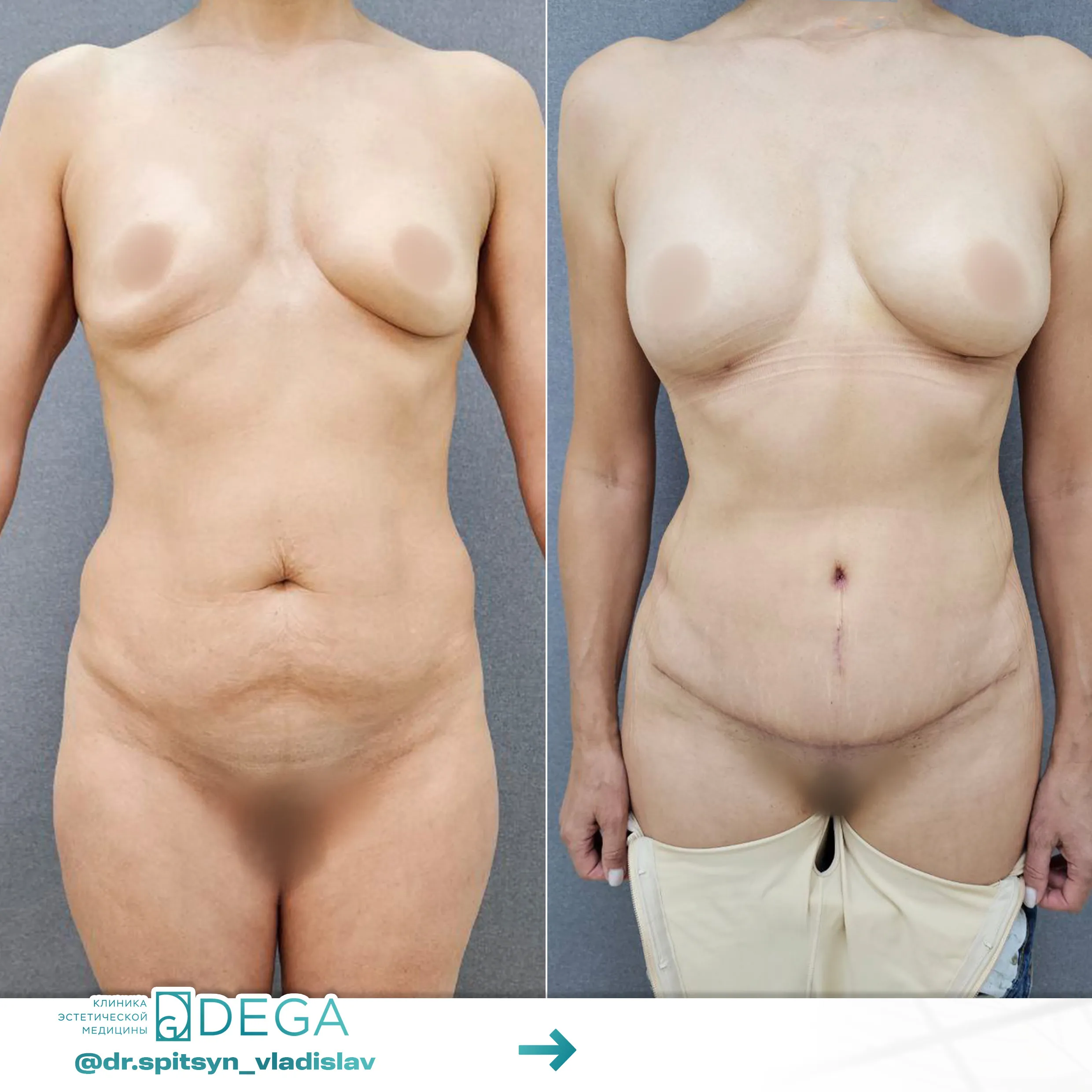 Спицын ВИ - Абдоминопластика, Липосакция тела, Липофилинг груди №44