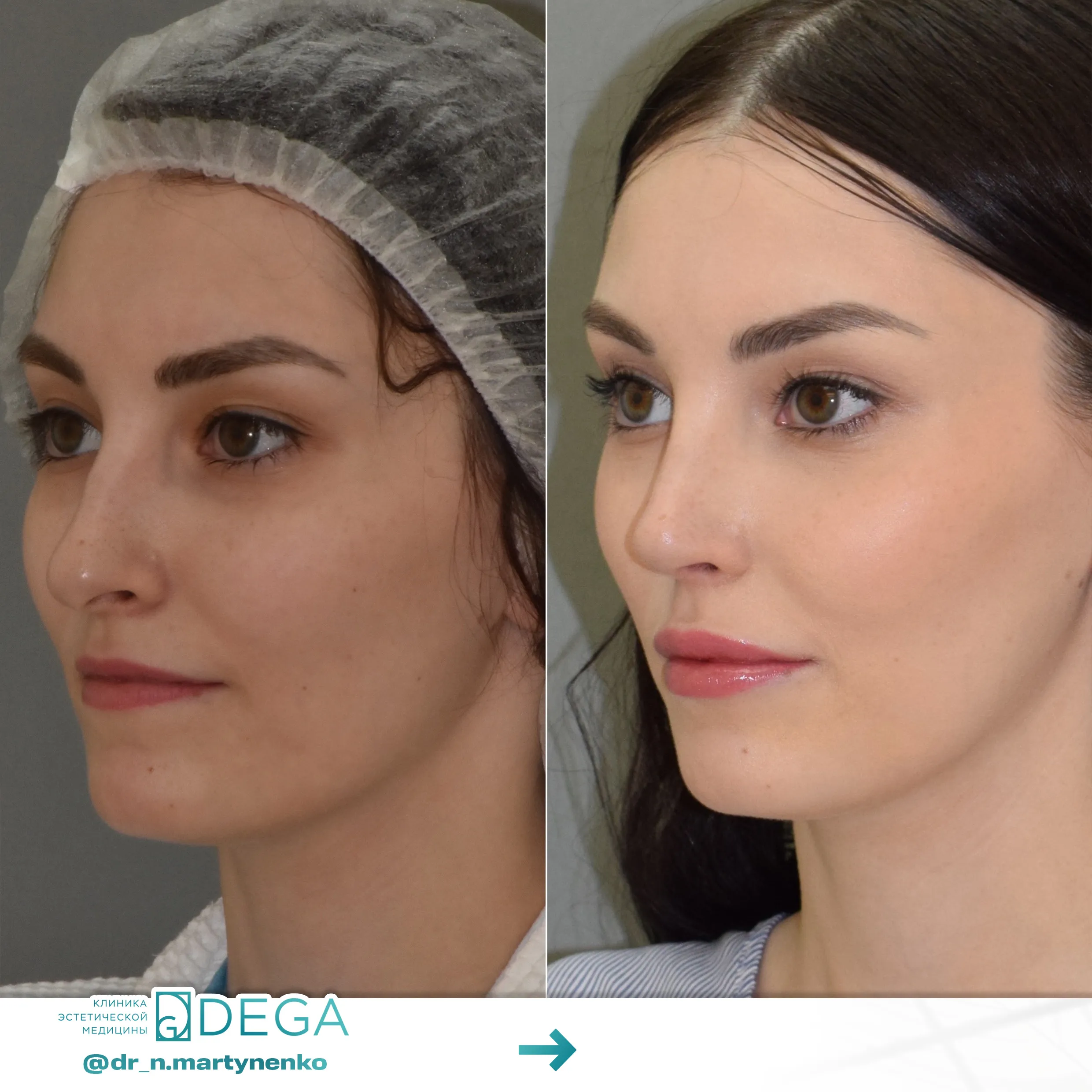 Мартыненко Н. А. — Ринопластика  №1