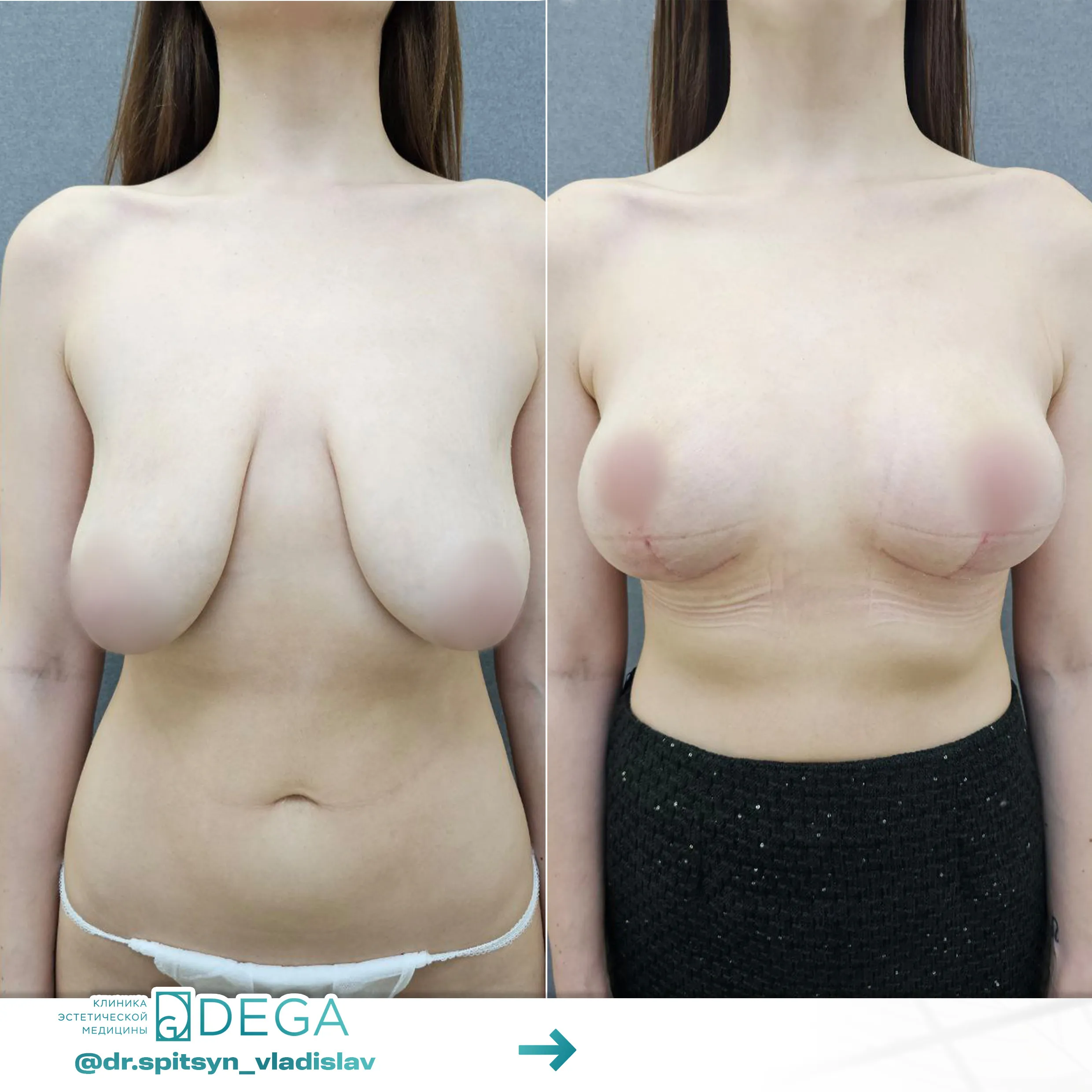 Спицын ВИ - Мастопексия (подтяжка груди) №46