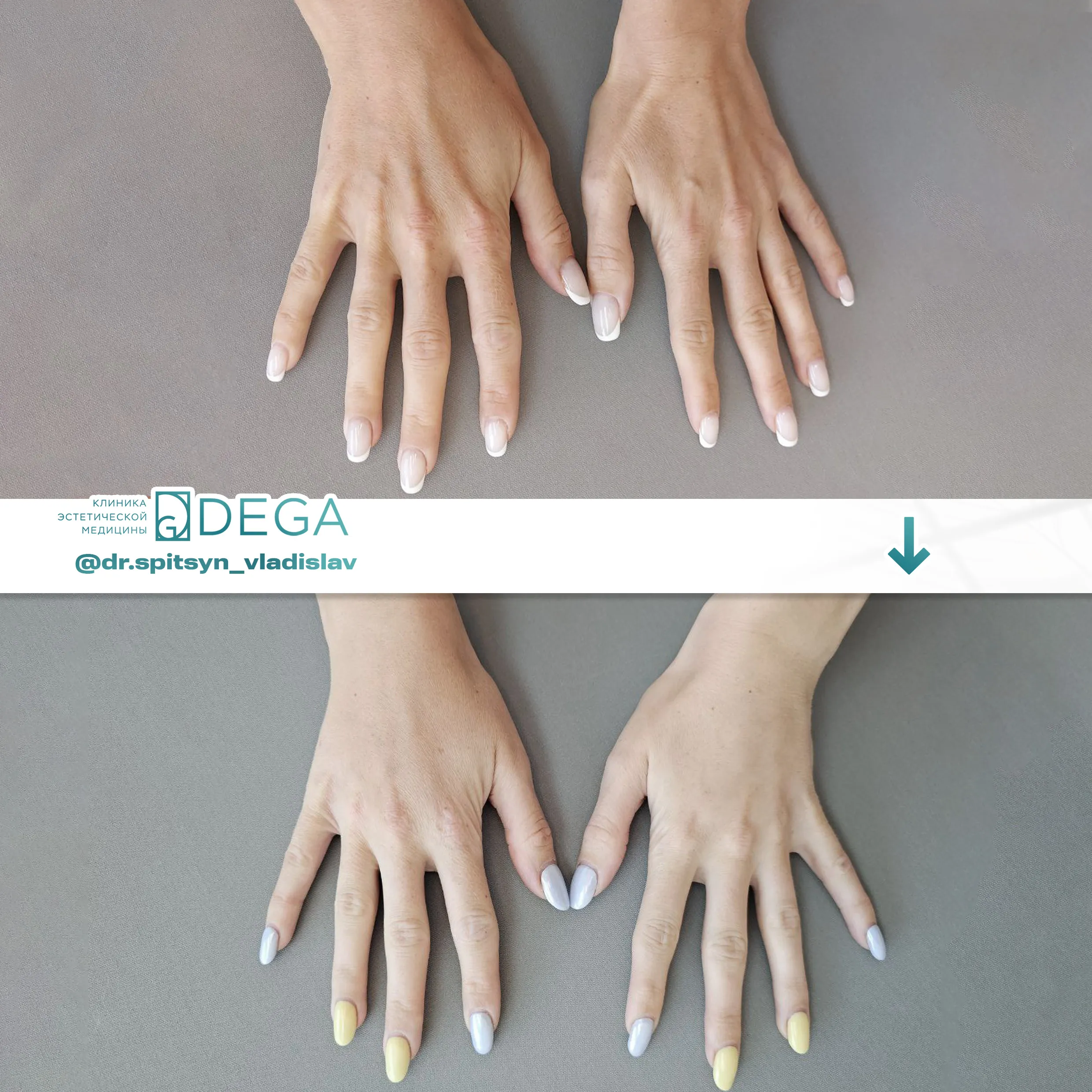 Спицын ВИ - Липофилинг рук №55