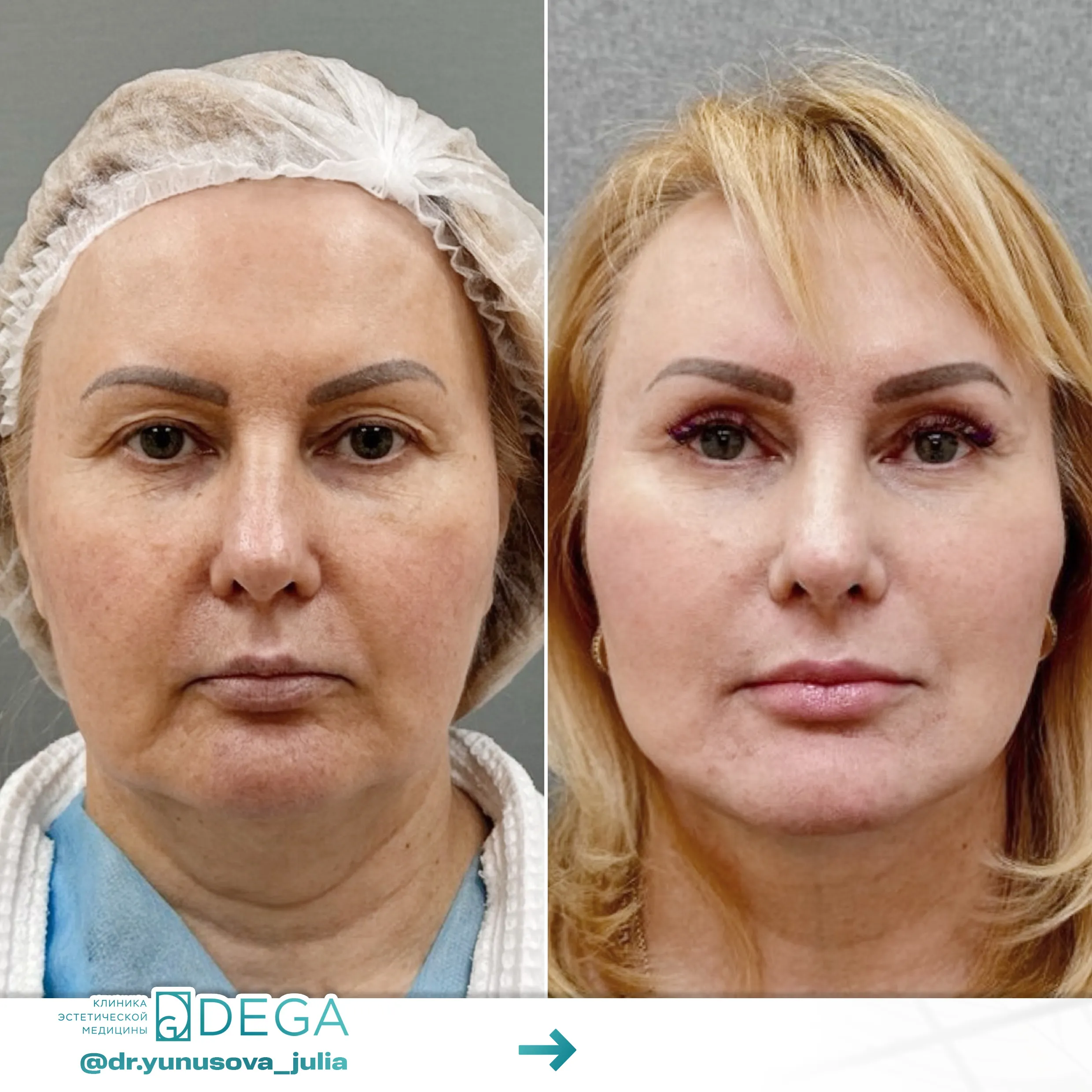 Юнусова ЮР - Эндоскопическая подтяжка лица, Фейслифтинг, Платизмопластика №61