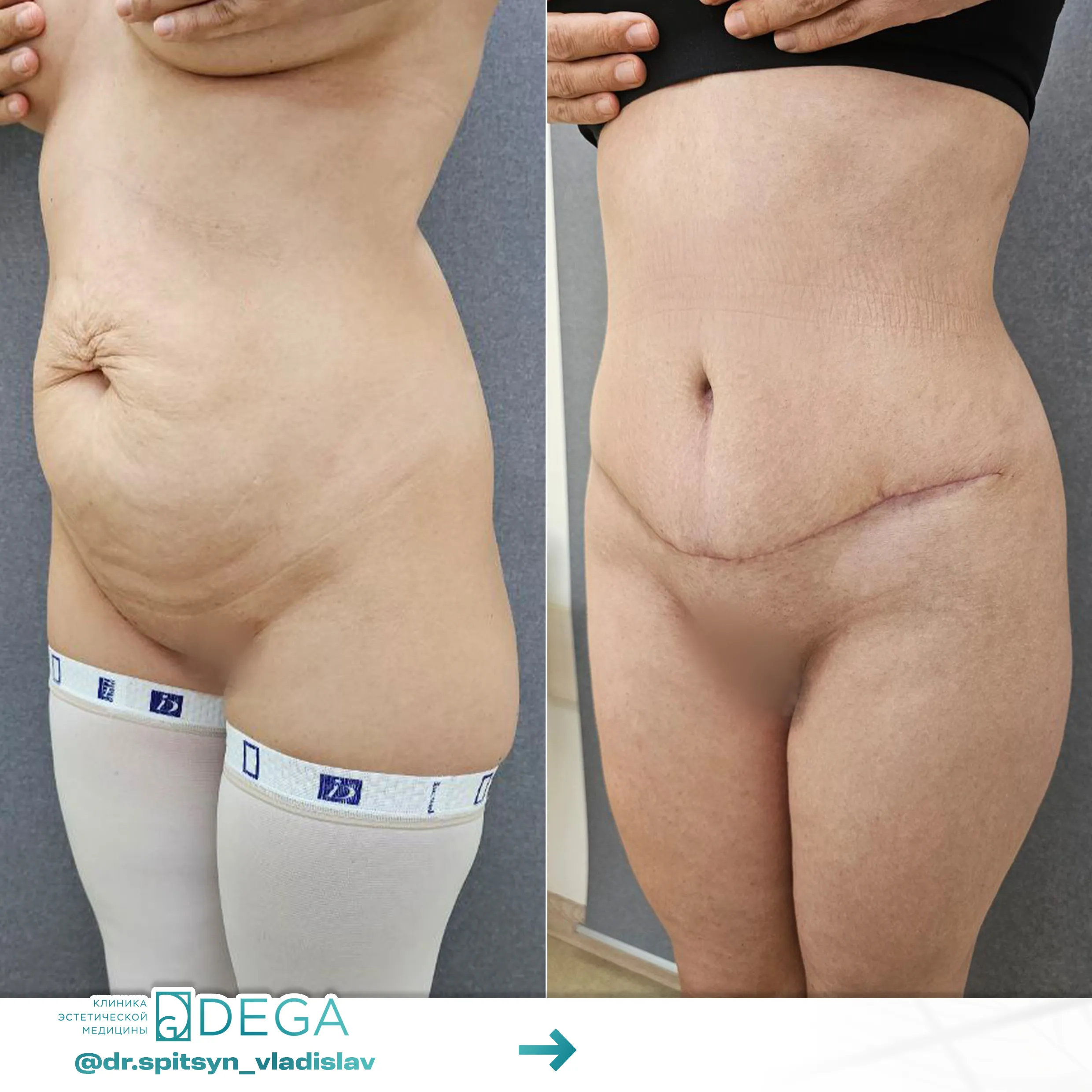 Спицын ВИ - Абдоминопластика, Липосакция тела, Липофилинг бедер №43