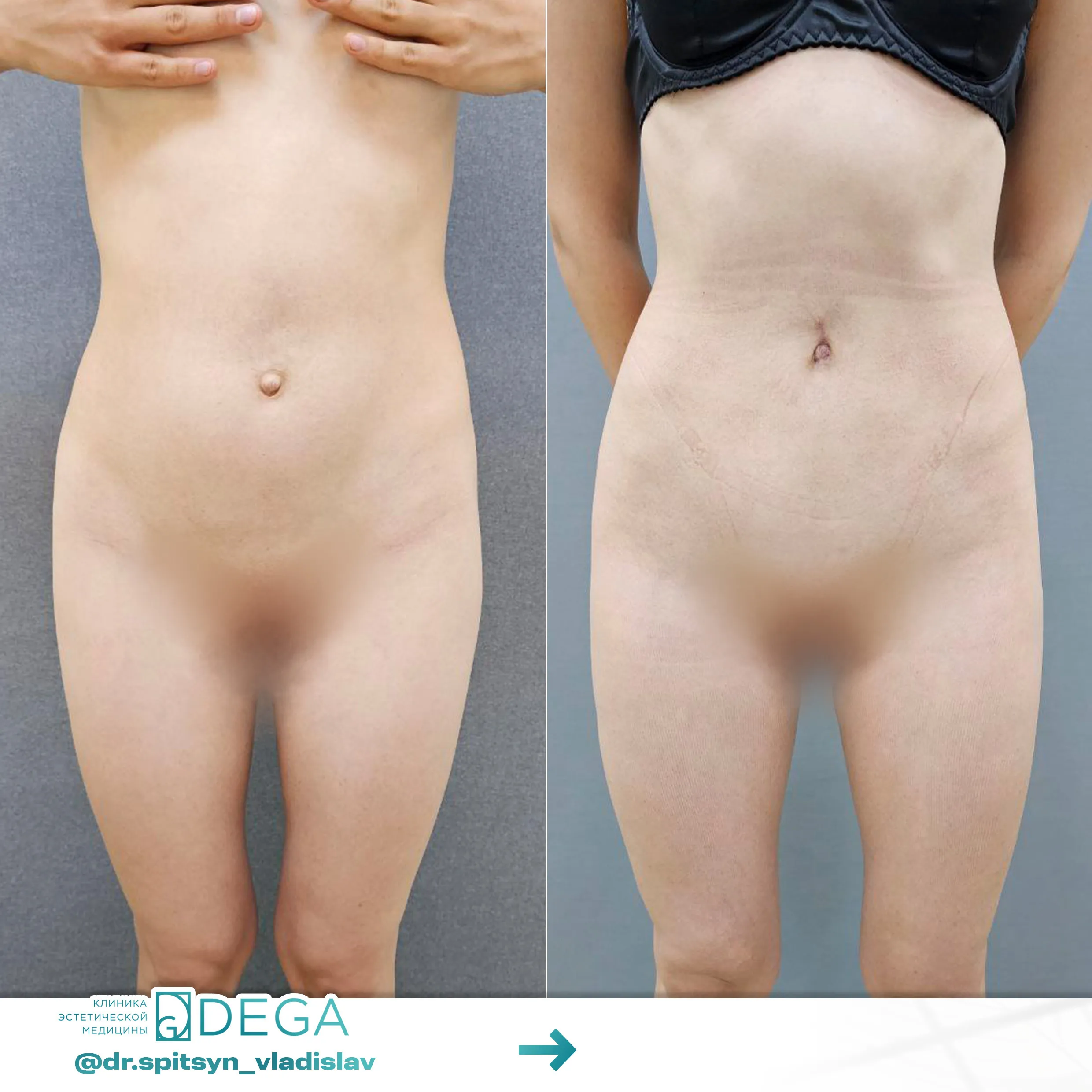 Спицын ВИ - Увеличение груди №61