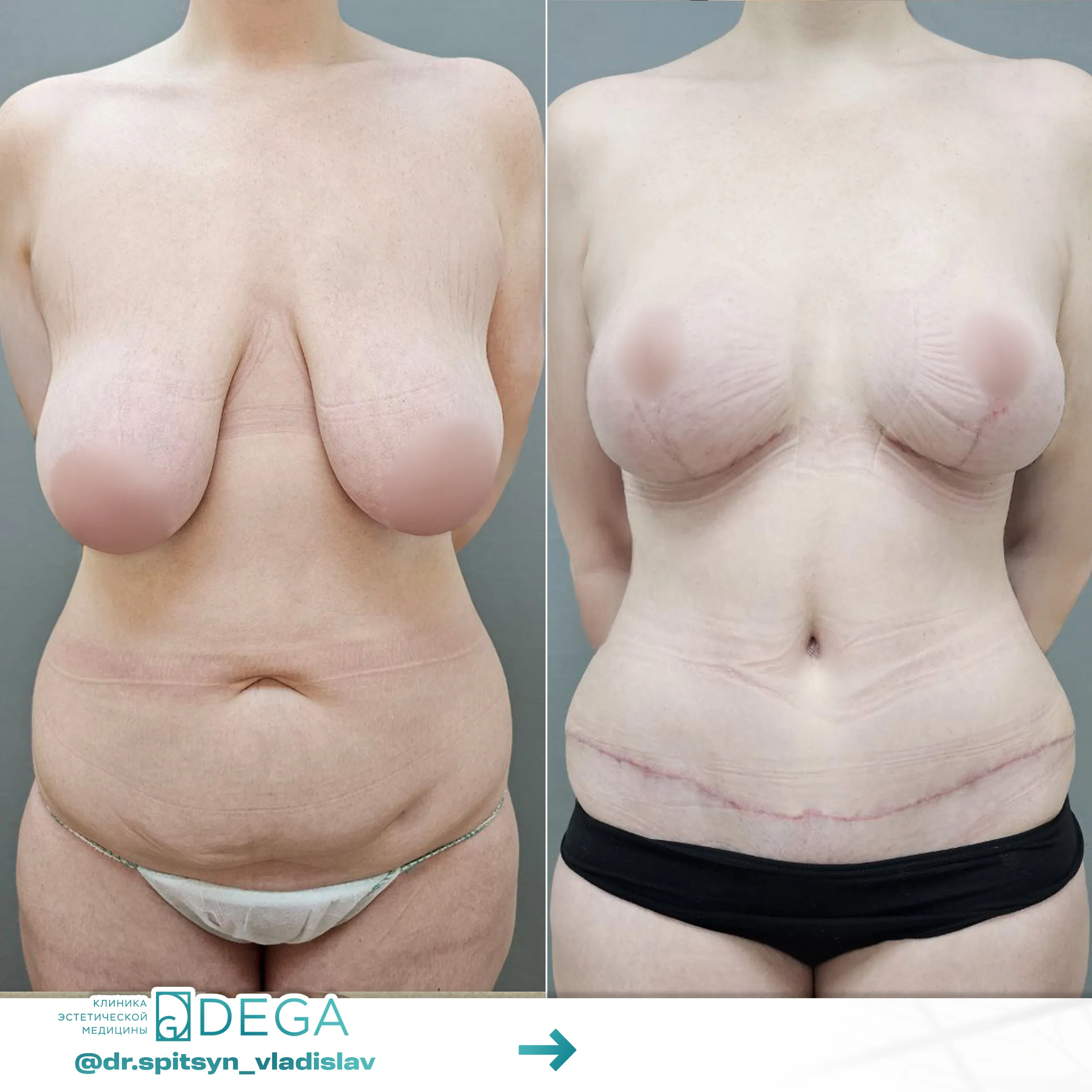 Спицын ВИ - Мастопексия (подтяжка груди), Абдоминопластика (пластика живота) №48